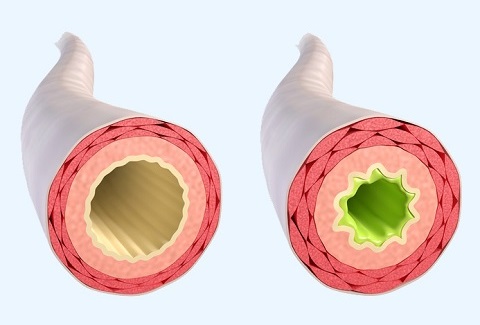 Asthma bronchiale – Symptome Asthma bronchiale – Symptome
