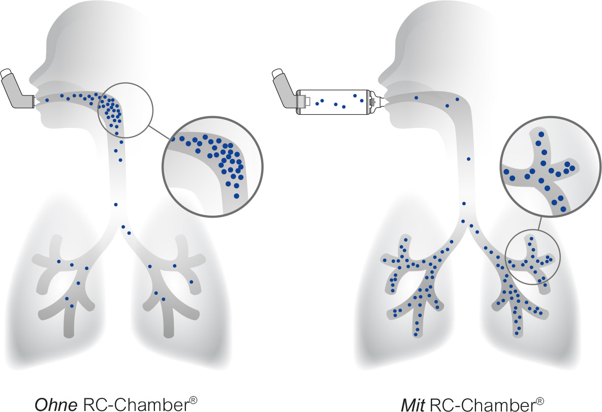 Die Wirkung der RC-Chamber® Therapie