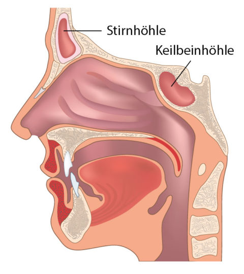 Chronische Sinusitis – Ursachen, Symptome, Therapie