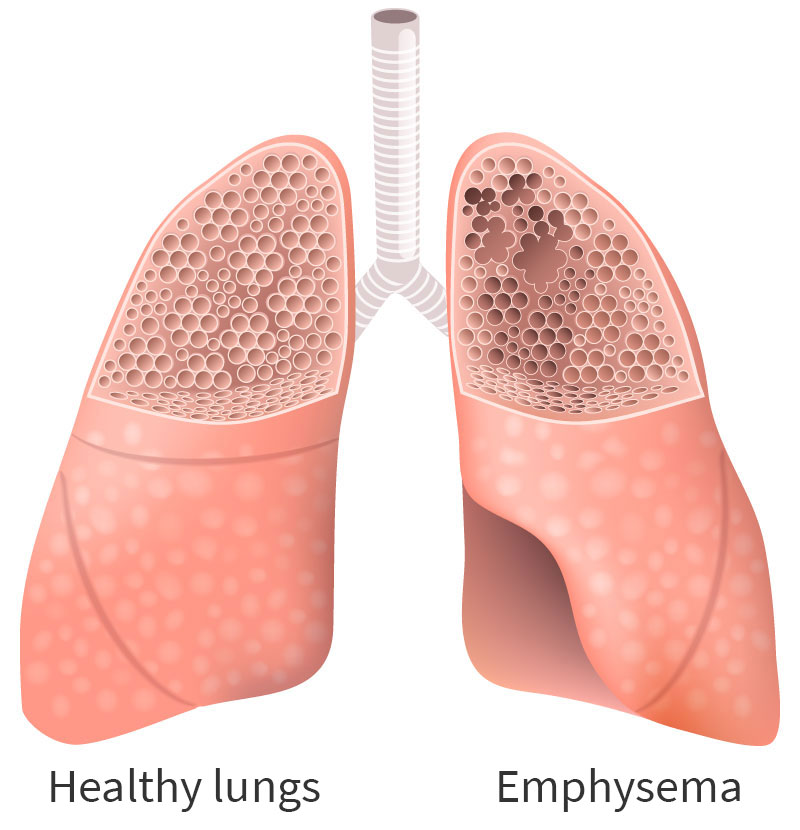 healthy lungs emphysema