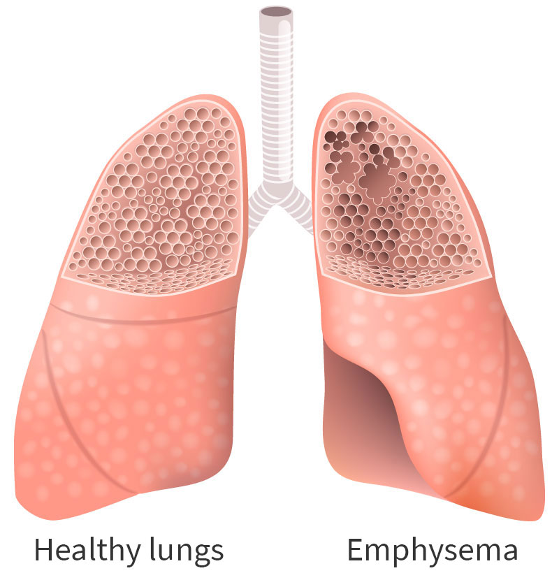 healthy lungs emphysema healthy lungs emphysema