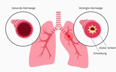 Asthma bronchiale – Symptome