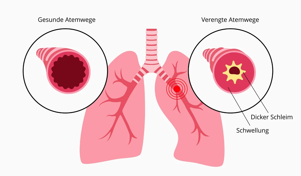 Asthma bronchiale – Symptome