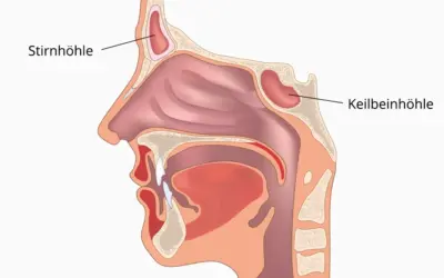 Chronische Sinusitis – Entzündung der Nasennebenhöhlen