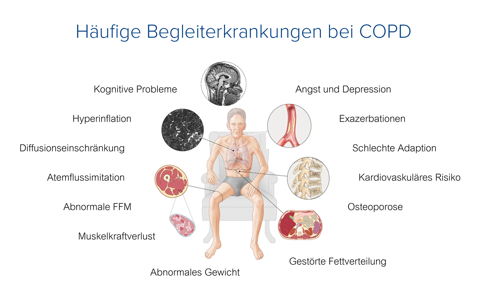 Schaubild der typischen Begleiterkrankungen bei COPD